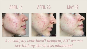 Ali Gua Sha pomaga pri aknah
